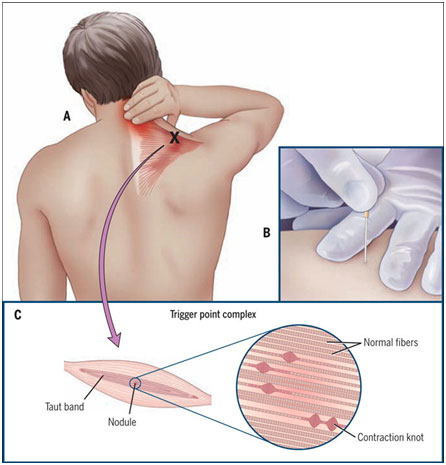 illustration expliquant le trigger point en kinesitherapie